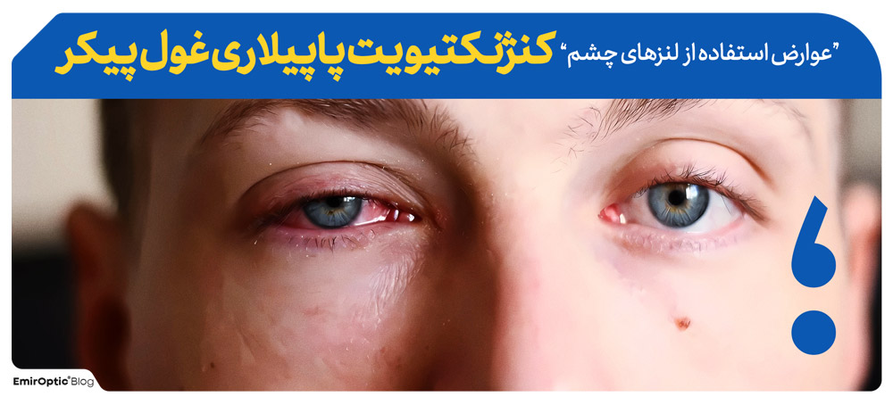 کنژنکتیویت پاپیلاری غول پیکر