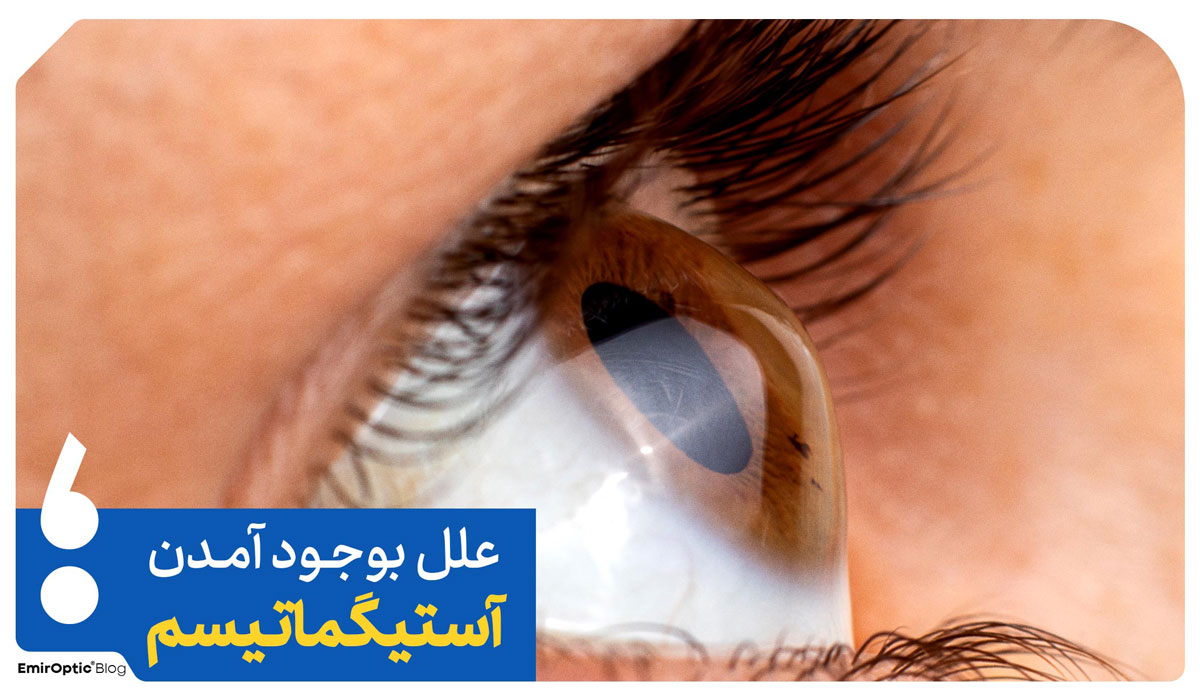 علت چشم آستیگمات