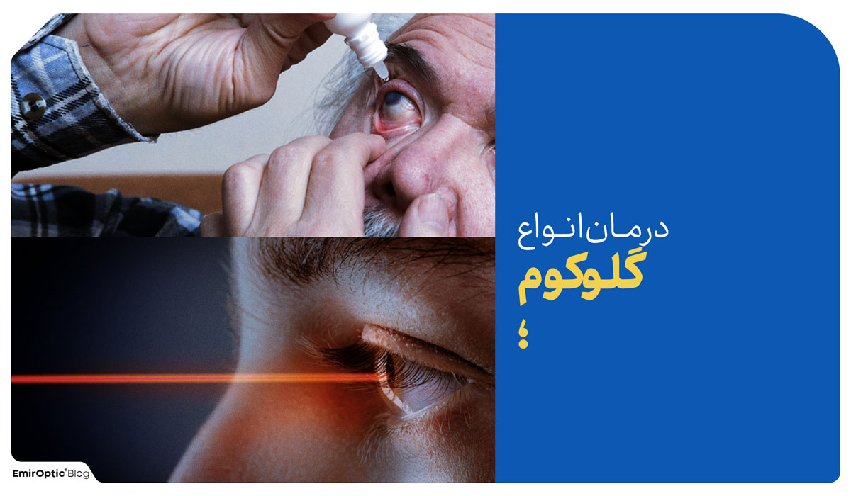 درمان گلوکوم آب سیاه چشم