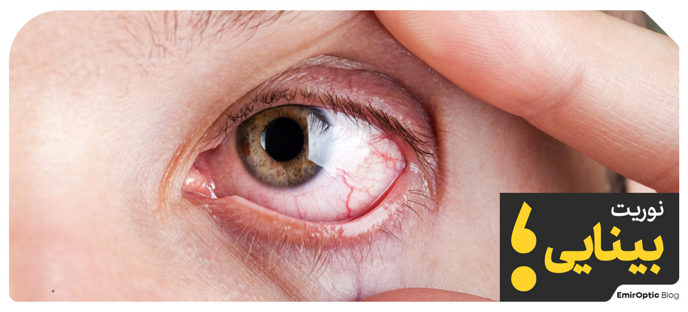 نوریت اپتیک optic neuritis