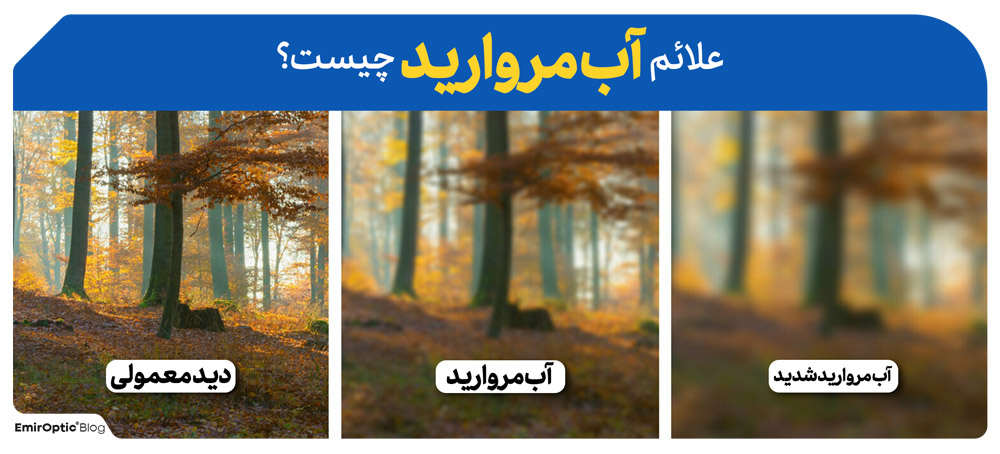 علائم آب مروارید چیست؟