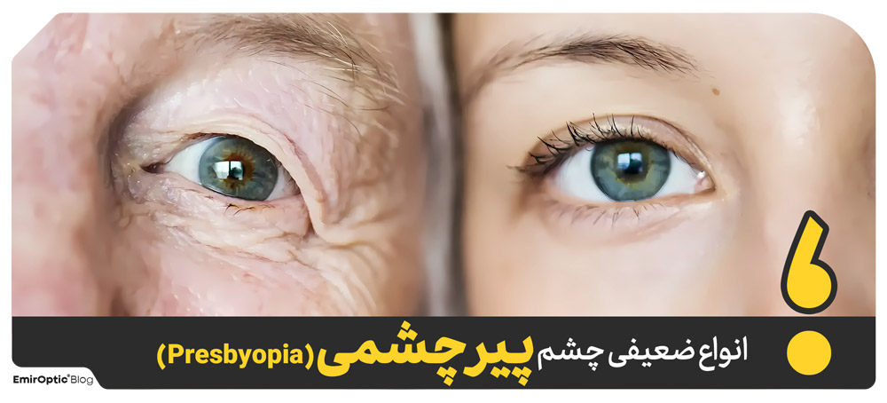 پیرچشمی (Presbyopia)