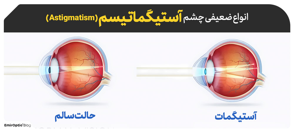 آستیگماتیسم